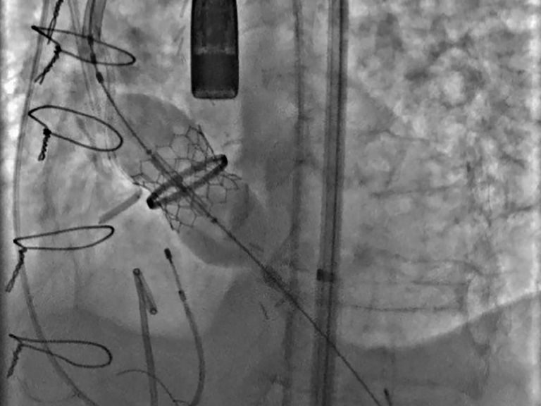 Immanuel Herzzentrum Brandenburg - Implantation der neuen Klappe in den verbliebenen Ring der mechanischen Klappe